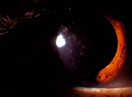 Epidemični keratokonjunktivitis