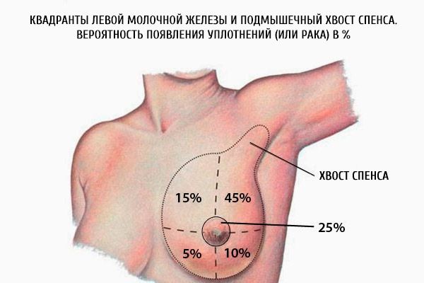 Kvadrante leve dojke in aksilarna veriga sprednje plošče.  Verjetnost tesnjenja (ali raka) v%