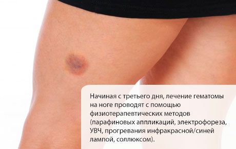 Zdravljenje hematoma na nogi