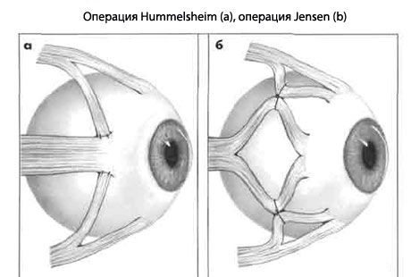 Strabismus - operacija