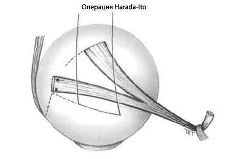 Strabismus - operacija