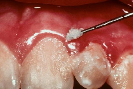Zobje in gingivitis