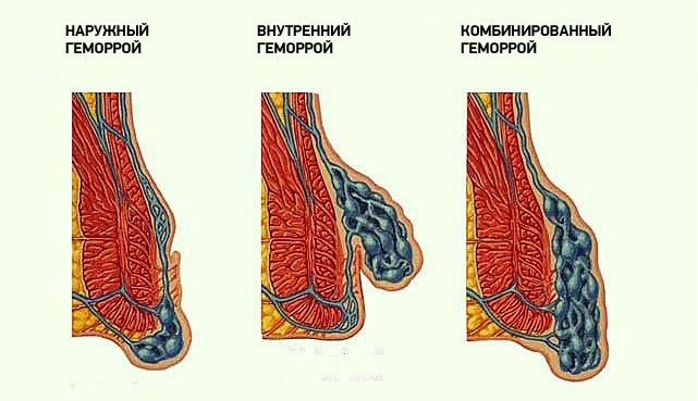 Še vedno obstajajo akutni in kronični hemoroidi